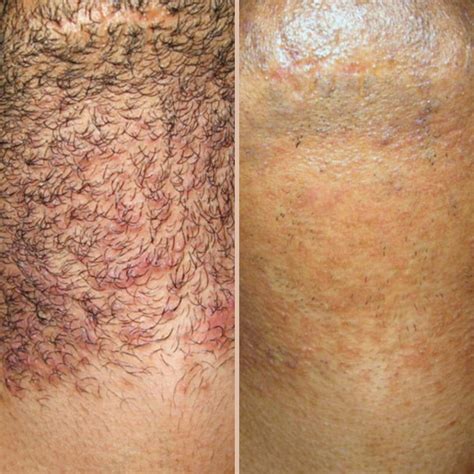 yag laser huddersfield|Laser Hair Removal .